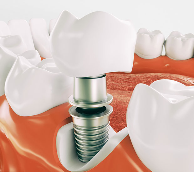 Newport Beach Dental Implant Restoration