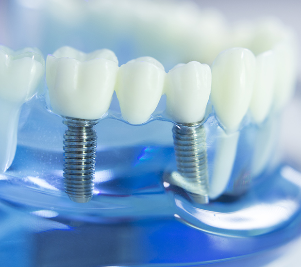 Newport Beach Dental Implants